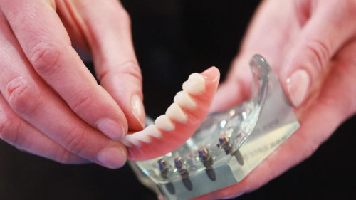 fort-worth-dentist-snap-on-dentures