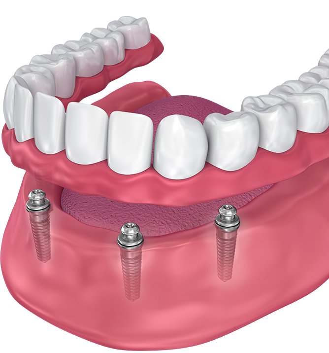 fort-worth-dentist-snap-on-dentures