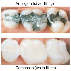 composite-fillings