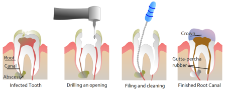 root-canal-procedure