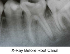 root-canal-procedure