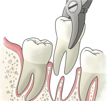 tooth-extractions